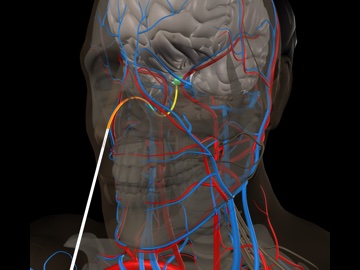 A concentric tube robot maneuvering through the nasal cavity to the pituitary gland in a simulated skull base suergery procedure.