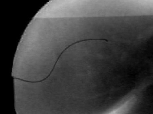 A steerable needle in ex vivo liver tissue